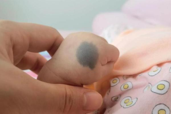 身体上的胎记位置不同算命分析