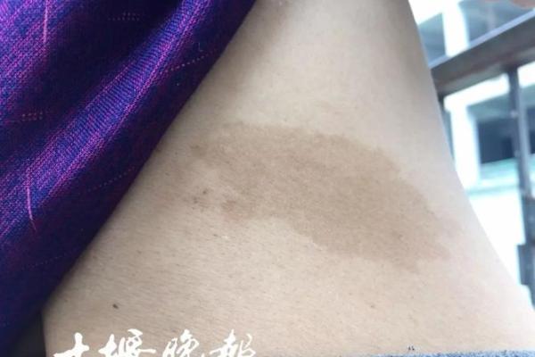 如何根据背部胎记算命-