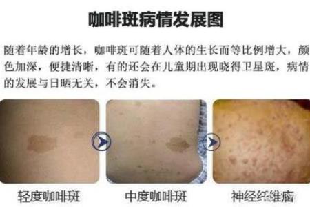 据脖子上胎记算命，有什么说法
