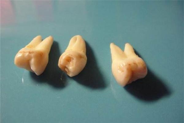 牙齿算命 有鬼牙不吉利吗